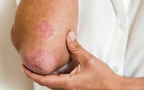 Psoriasis, which can involve the skin, nails and joints, is a chronic, painful, disfiguring and disabling noncommunicable disease (ncd) for which there is no cure. Psoriase Desistir Nao E Opcao Atlas Da Saude
