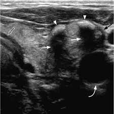 Ultrasound is used to see the thyroid or the lymph node (s) during the biopsy, which helps make sure they are getting fna samples from the right areas. Ultrasound Investigations In Head And Neck Cancer Patients Springerlink