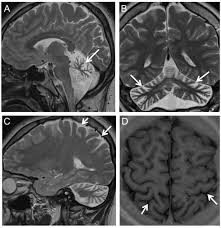 Phenotype and frequency of STUB1 mutations: next-generation screenings in  Caucasian ataxia and spastic paraplegia cohorts