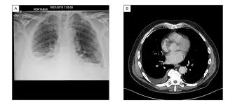 Malignant mesothelioma is an uncommon cancer that can develop in the pleura or the peritoneum 1. Malignant Mesothelioma Presenting After Resolution Of A Seemingly Benign Asbestos Related Pleural Effusion European Medical Journal