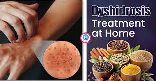 Image result for dyshidrosis