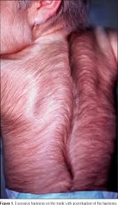 Image result for Hypertrichosis