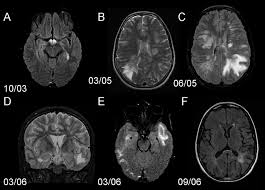 Pediatric neurologist david pleasure is studying how inflammation of white matter contributes to certain autoimmune disease like multple sclerosis. Figure 3 Spectrum Of Pediatric Neuromyelitis Optica American Academy Of Pediatrics