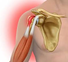 The shoulder bones can easily be affected by falls or learn more about the shoulder bones and the anatomy of the upper extremity (including the hand, wrist. What Is An Biceps Tendon Tear At The Shoulder Treatment For Biceps Tendon Tear At The Shoulder Orthopedic Knee Doctor Miami Doral