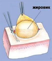 как избавиться от кашля у ребенка в домашних условиях Kak Ubrat Zhirovik V Domashnih Usloviyah Zdorove Zhenskoe Zdorove Alternativnaya Medicina
