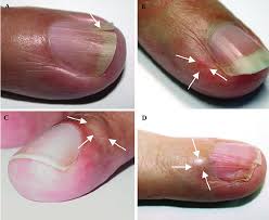 fingernail and nailbed abnormalities in