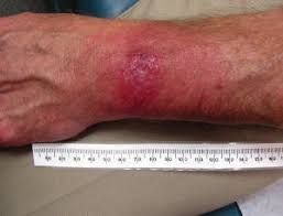 Pour Les Professionnels De La Sante Maladie De Lyme Canada Ca