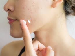 Boxcar Scars: Home Treatments, Causes, And Outlook