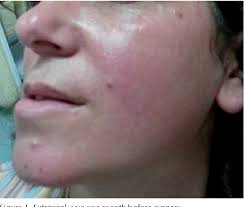 Figure 1 from Epidermoid Cyst of Mandible Ramus: Case Report