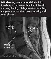 Lumbar Spondylosis Mri Mri Radiology Sinus Cavities