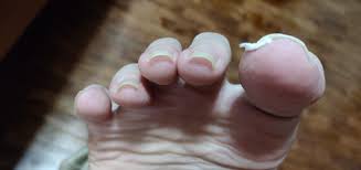 Manscaped nail grooming kit includes clippers, file, scissors, tweezers, ear pick, & case. Are My Toenails Too Curved What Is The Proper Way To Cut It How Can I Make It More Straight Curved Toenails Dig In The Skin Help Please Ingrown Toenails