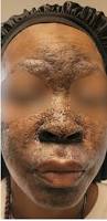Image result for Diffuse Hyperpigmentation