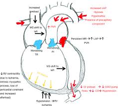 Image result for Right Heart Failure