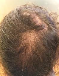 I was on the forums daily, i would rack the brains of guys i considered veterans in the community, i would listen to gurus, and i would. It Is Not Invisible A Case Report Of 2 Patients With Scalp Lichen Planopilaris Mimicking Androgenic Alopecia