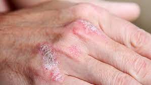 Psoríase é uma doença crónica da pele, muito comum e não contagiosa. Psoriase Pode Ser Confundida Com Outros Problemas De Pele Drauzio Varella Drauzio Varella