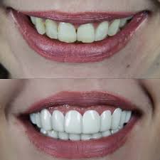 Do snap on veneers look real? Presson Veneers Brighter Image Lab Official Site Bil Veneers Veneers Teeth Dental Veneers Snap On Smile