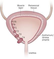 Image result for Bladder Cancer Staging