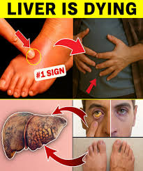 Here are 8 warning signs of liver disease