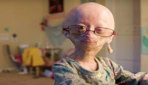 Wow Meet This 11 Year Old Girl Suffers From Rare Ageing Syndrome And Have Millions Of Fans On Youtube Catch News