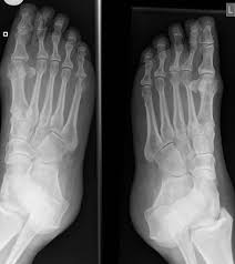 Rheumatoid Arthritis Feet Radiology Case Radiopaedia Org