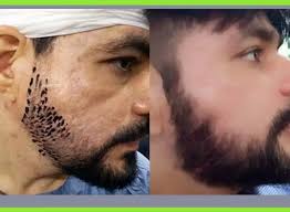 But by far, one of the most common and popular styles nowadays is the lumberjack beard. Beard Hair Transplant In Mumbai 9222222407 9222222605 Hair Transplant Clinic In Mumbai With Anagen Clinic Pvt Ltd