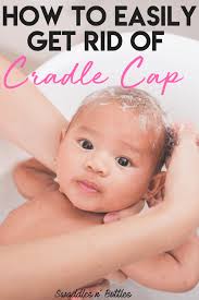 How To Encourage Development In Your 0 3 Month Old Newborn Swaddles N Bottles Baby Cradle Cap Cradle Cap New Baby Products