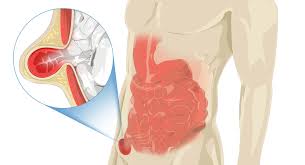 The inguinal hernia occurs when a section of the small intestine or fat pocket from the abdomen snakes down into the tubular canal that runs through the abdominal wall and pops out of a weakness in the peritoneum. Inguinal Hernia Niddk