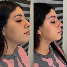 ✨ RINOMODELACIÓN SIN CIRUGÍA ✨ Transforma el perfil de tu rostro en  minutos, sin bisturí y con resultados inmediatos. 👨‍⚕️ Dr. Jesús Magallanes  📍 Medicina estética y antienvejecimiento 💉 Armonizamos: ✔️ Punta