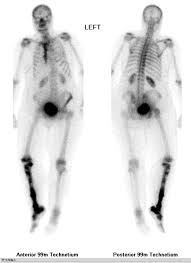 Primary bone cancer is a rare type of cancer that begins in the bones. A Hot Leg A Rare Case Of Isolated Long Bone Metastases From Cervical Cancer Anticancer Research