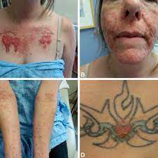 Allergic Reaction To Red Tattoo Ink And Autoeczematization A Download Scientific Diagram