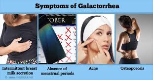 Image result for Galactorrhea