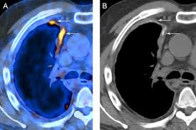 Ct is most commonly used for imaging assessment of mesothelioma, and sufficient for accurate staging of . Imaging Of Malignant Pleural Mesothelioma Pearls And Pitfalls Sciencedirect