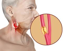 Image result for carotid artery