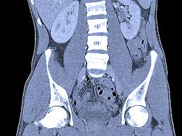 Ct scans and mri scans are two medical imaging methods that create detailed images of internal body parts, including bones, joints, and organs. Abdominal Ct Scans Definition Uses Picture And More