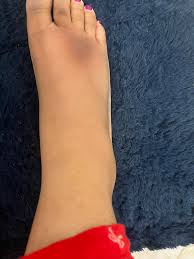 Image result for brown patches on the feet