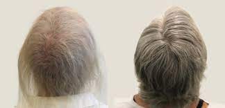 Hair loss is a common side effect of chemotherapy, although it does not happen to everyone. General 3 Nhl Med Aesthetics