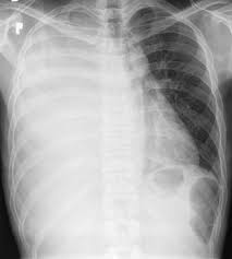 What does a chest x ray reveal? Ring Complaints As A Rare First Symptom Of Malignant Pleural Mesothelioma Thoracic Key