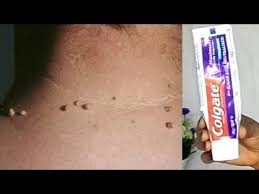 Remove Skin Tag In 1 Night Of Applying Toothpaste Youtube Skin Tag Removal Skin Tags Home Remedies Skin Tag