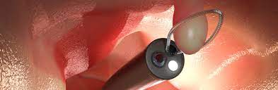 Rektoskopie, sigmoidoskopie und koloskopie ). Mooci Darmpolypen Gestorte Verdauung Mit Folgen