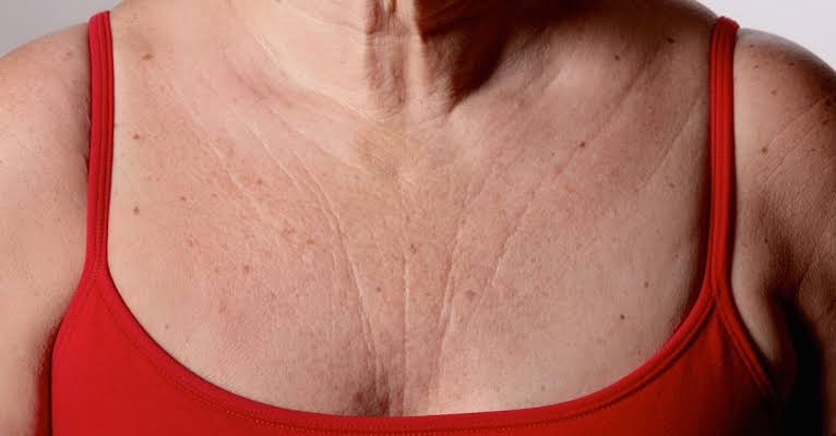 Image result for cheast wrinkles