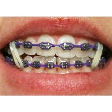 Purple Braces Braces Rubber Bands Braces Bands Cute Braces