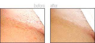 It's a more permanent hair removal treatment than waxing or shaving. Paperback Play Sports Studio Pubic Laser Hair Removal Before And After Jungodaily Com