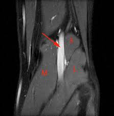 Magnetic resonance imaging (mri) is the test of choice to confirm the diagnosis of a torn meniscus. Accessory Muscles Of The Knee Radsource