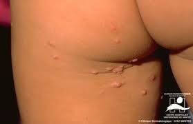 Image result for itchy skin rectum