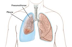 Image result for Pneumothorax