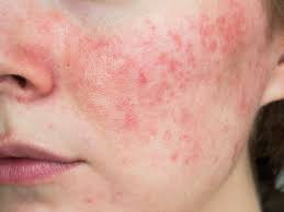 Image result for vyrážka u dětí