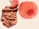 Stomach cancer is an abnormal growth of cells that begins in the stomach. à¤ª à¤Ÿ à¤• à¤• à¤¸à¤° à¤• à¤‡à¤¨ à¤²à¤• à¤·à¤£ à¤• à¤•à¤­ à¤¨ à¤•à¤° à¤‡à¤— à¤¨ à¤° Most Ignored Symptoms Of Stomach Cancer That You Need To Know Hindi Boldsky