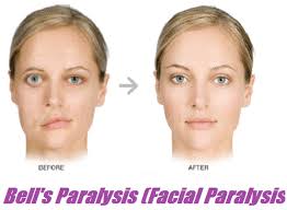 Research shows bell's palsy afflicts approximately 40,000 americans every year. Bell S Palsy Causes Symptoms Natural Treatment Bhb Tips