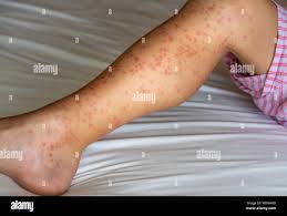 Image result for Papular urticaria