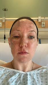 Hey everyone, I just thought I'd give a quick little update of how I'm  doing. I suffered burns to around 20% of my body, my face and hand  included. I'm taking recovery